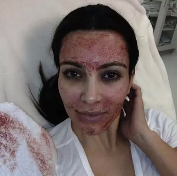 LE BUZZ - Le visage défiguré de Kim Kardashian